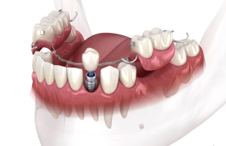 Які протези краще обрати? Коли у людини настає процес втрати зубів, а від цього не застрахований ніхто, постає питання який зубний протез краще обрати.