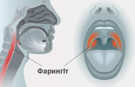 Фарингіт – це запальне захворювання слизової оболонки горла, яке може виникати як у самостійному вигляді, так і бути наслідком інших інфекцій, таких як грип чи застуда.