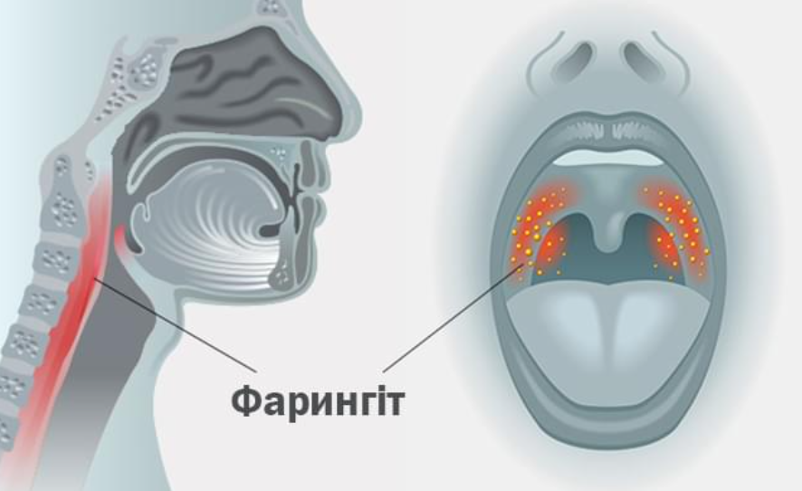 як впоратися з фарингітом